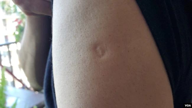 Cicatriz en el brazo evidencia inmunización contra la viruela, se aplicó hasta 1980 poco después que que OMS diera por erradicada la enfermedad en todo el mundo. (Foto VOA / Tomás Guevara)