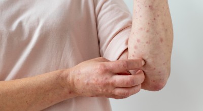 Las autoridades sanitarias de Minnesota han confirmado el primer caso de sarampión del año